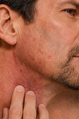 Mature man with mild razor burn and one visible ingrown hair after shaving with an unsuitable blade
